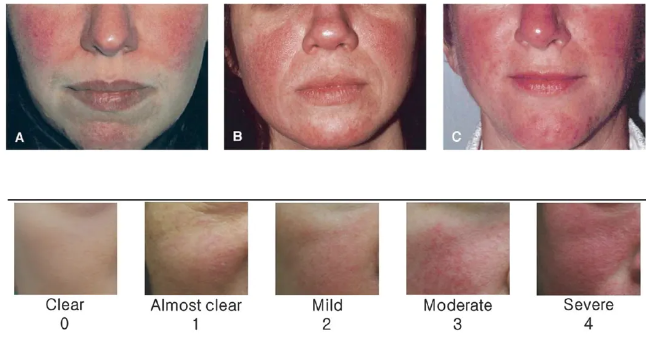 IPL Skin rejuvenation Rosacea removal beauty machine